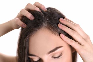 apa-itu-ketombe-dan-bagaimana-rambut-bebas-ketombe