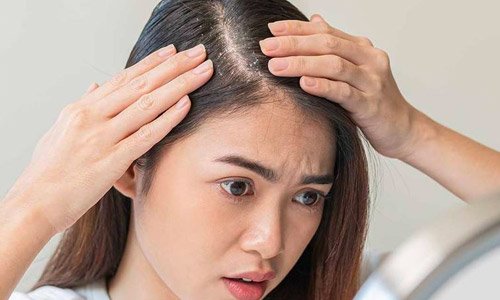 Catat! Begini 10 Cara Menghilangkan Ketombe Membandel