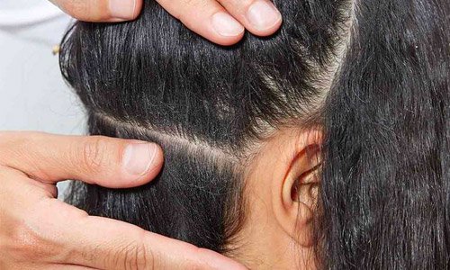 Ternyata, Ini 7 Penyebab Ketombe yang Wajib Dipahami