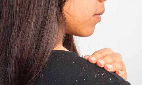 Ampuh! 10 Cara Menghilangkan Ketombe Kering