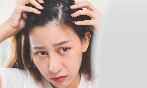 Wajib Coba! 10 Cara Menghilangkan Ketombe Secara Alami dan Permanen