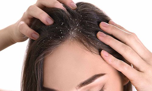 Apa Itu Ketombe dan Bagaimana Agar Rambut Bebas Ketombe?
