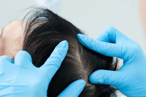 seseorang sedang mengamati penyebab rambut rontok parah pada wanita